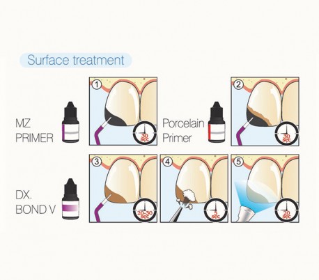 Dentex - DX.BOND V Adhesive