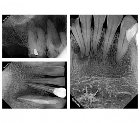 Eighteeth - NanoPix Digital X-Ray Sensor