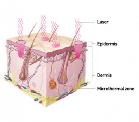 IDS - CO2 Fractional Laser Model Angela