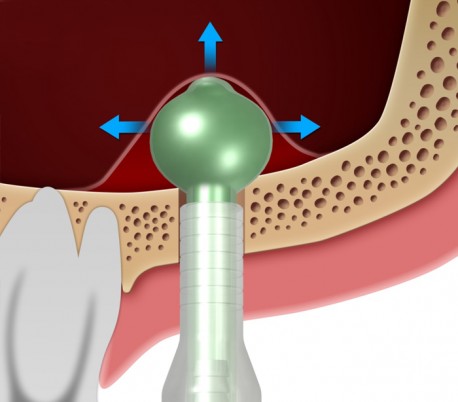 سینوس الواتور - Dentium