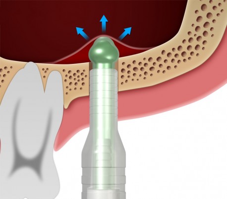 Dentium - Sinus Elevator