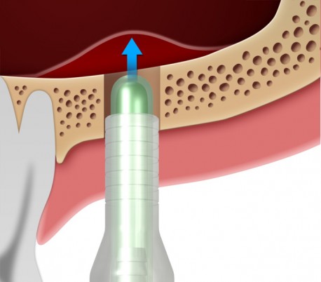 Dentium - Sinus Elevator