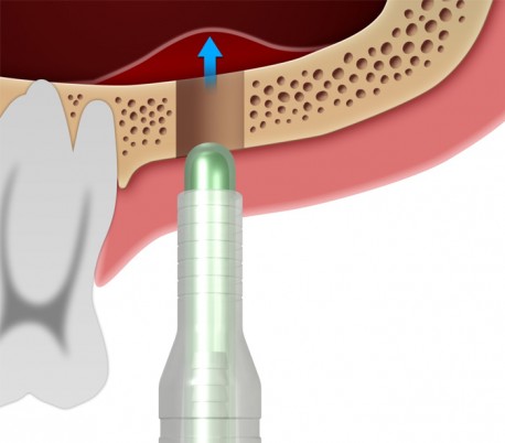 Dentium - Sinus Elevator