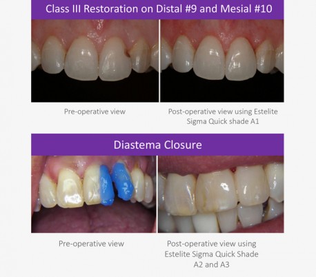 کامپوزیت رزینی Tokuyama - Estelite Sigma Quick