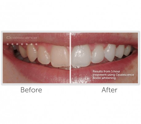 UltraDent - Opalescence Boost PF 40% Office Bleaching x1