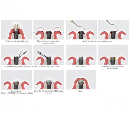 Dentium - TN-Brush for Peri-implantitis