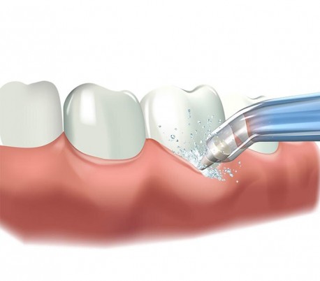 Waterpulse - DE-300 Periodontal Pocket Tip