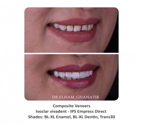 Ivoclar Vivadent - IPS Empress Direct Composite - Dentin