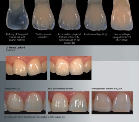 Ivoclar Vivadent - IPS Empress Direct Composite - Dentin