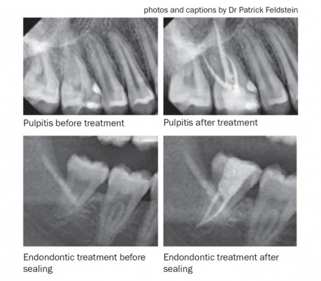 itena - MTA Bioseal Root Canal Sealer