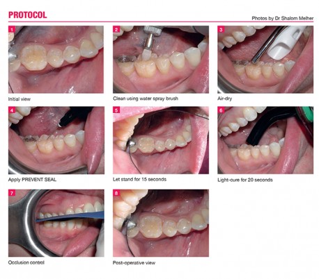 itena - Prevent Seal Pit & Fissure Sealant