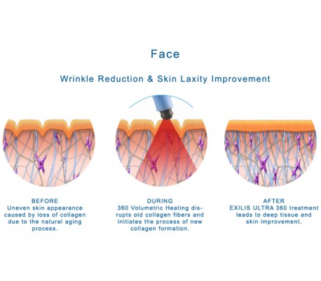 BTL Aesthetics - Exilis Ultra 360 Device