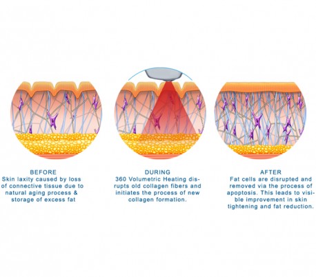 BTL Aesthetics - Exilis Ultra 360 Device