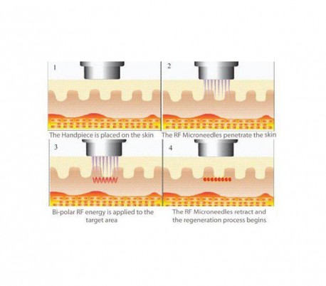 Jeisys - Ultracel  Hifu and RF Contouring Unit