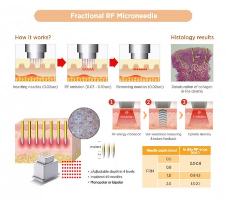 Jeisys - Ultracel  Hifu and RF Contouring Unit