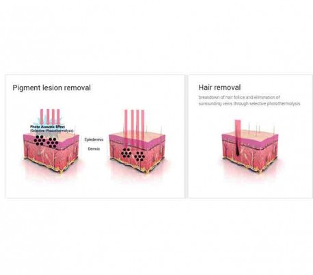 Wontech - Alexandrite and Nd: YAG Laser Model Sandro Dual