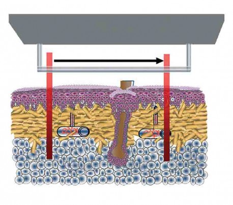 GME - Diode Laser Model LinScan