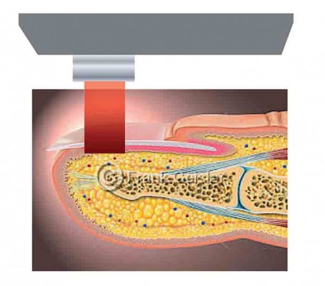 GME - Diode Laser Model LinScan