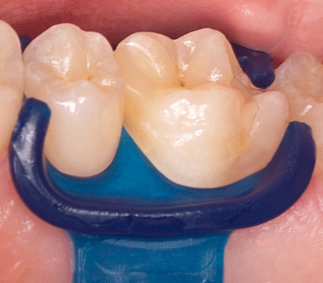 DMG - MiniDam Gingival Gaurd