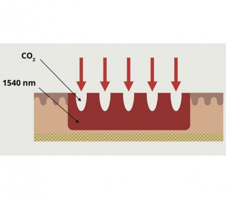 Deka - CO2 and IR Laser Model DOUGlide