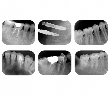 DentaFilm - SMART Digital Dental Image Plate Scanner