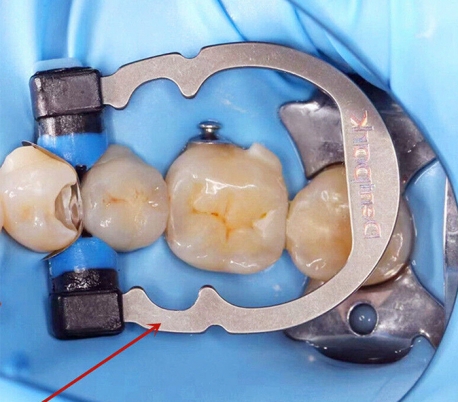 رینگ سکشنال تیتانیومی ZT Dental - 3D New