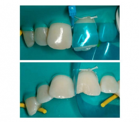 ZT Dental - Contoured Anterior Matrix