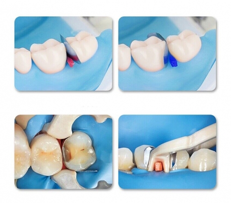 کیت نوار ماتریکس سکشنال به همراه رینگ رزینی ZT Dental - F2