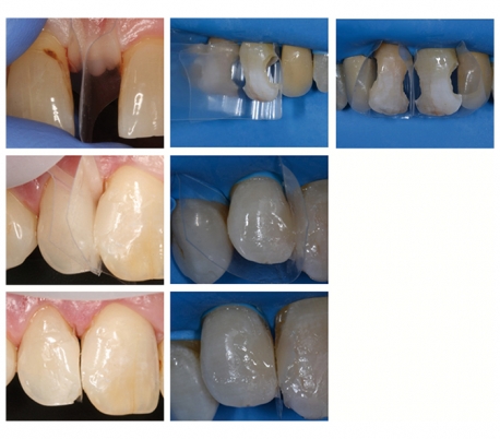 Directa - ProxyPal 3D Anterior Matrix