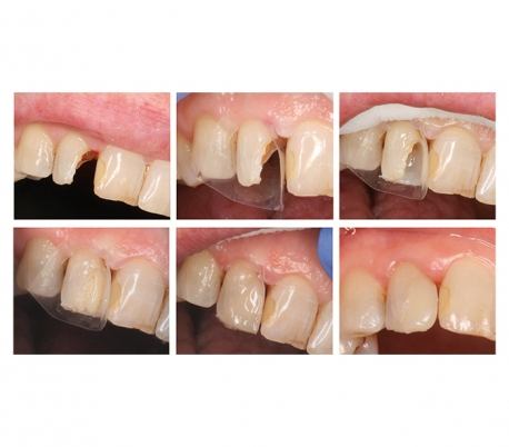 Directa - ProxyPal 3D Anterior Matrix