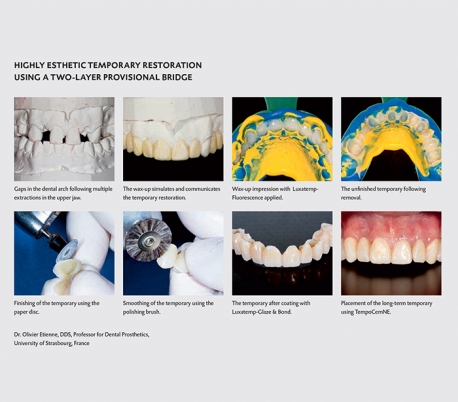 DMG - Luxatemp Fluorescence Temporary C&B Material