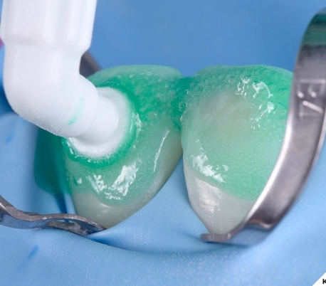 DMG - Icon Smooth Surface Caries Infiltrant