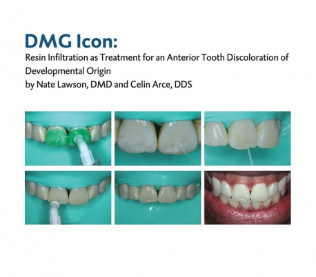 DMG - Icon Smooth Surface Caries Infiltrant