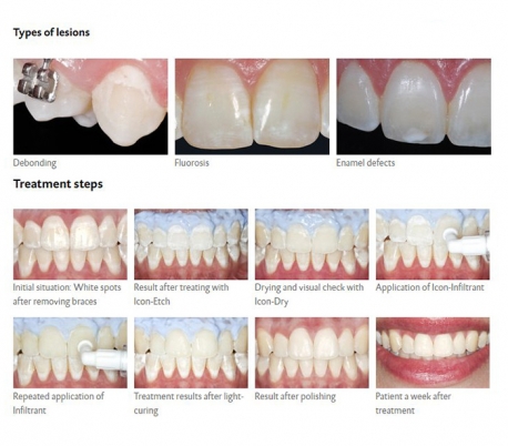 DMG - Icon Smooth Surface Caries Infiltrant