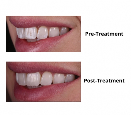 DMG - Icon Smooth Surface Caries Infiltrant