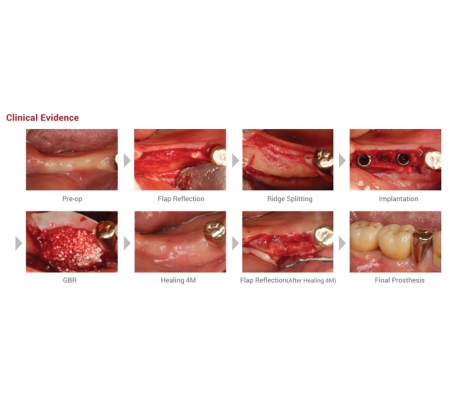 Genoss - OSTEON II Sinus Bone Graft Syringe