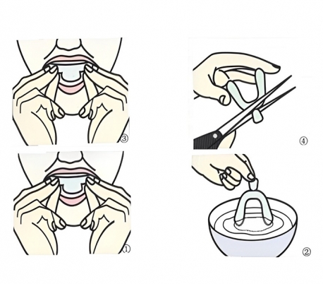 تری بلیچینگ ترموفرم - AV Dental