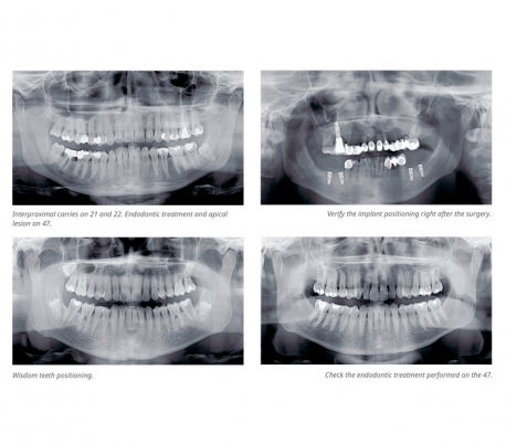 Acteon - X-mind prime 2D Panoramic X-ray System