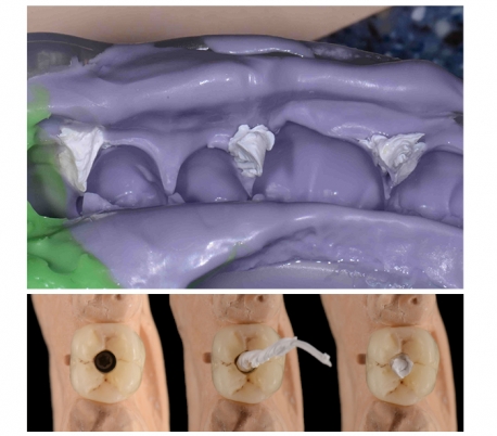 ZT Dental - Teflon Matrix Bands Roll