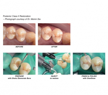 Shofu - Beautifil Injectable XSL Composite