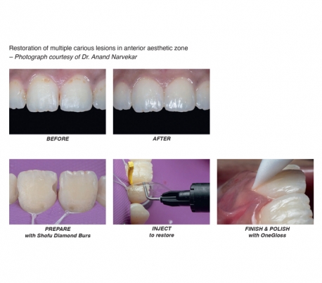 کامپوزیت فلو Shofu - Beautifil Injectable XSL