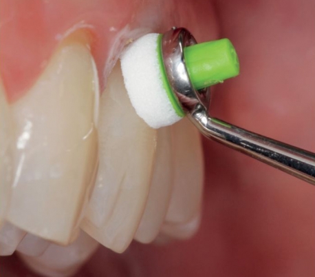 Fattah Teb - OptraSculpt Composite Instrument