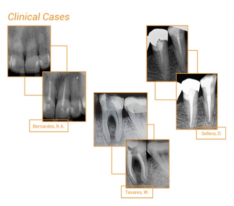 Angelus - Bio-C Bioceramic Root Canal Sealer