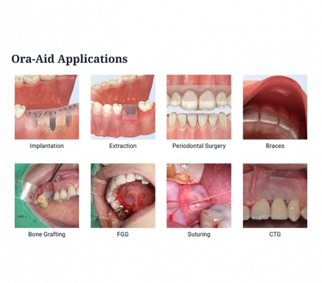 چسب زخم داخل دهانی TBM - Ora-Aid