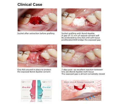 TBM - Ora-Aid Intraoral Wound Dressing