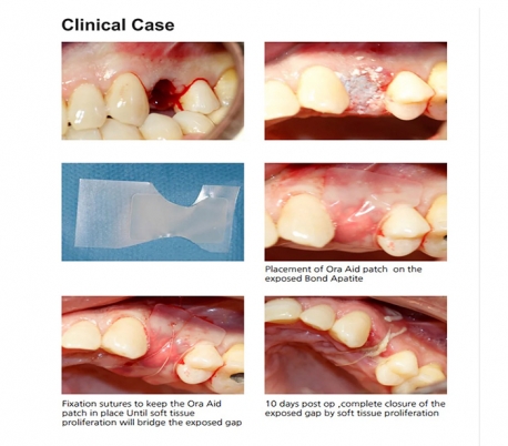 TBM - Ora-Aid Intraoral Wound Dressing