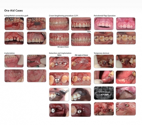 TBM - Ora-Aid Intraoral Wound Dressing