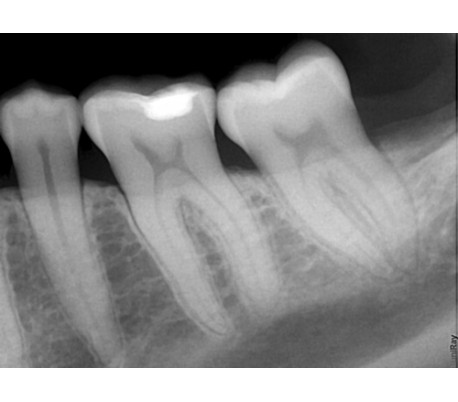 Suni - SuniRay2 Digital X-Ray Sensor