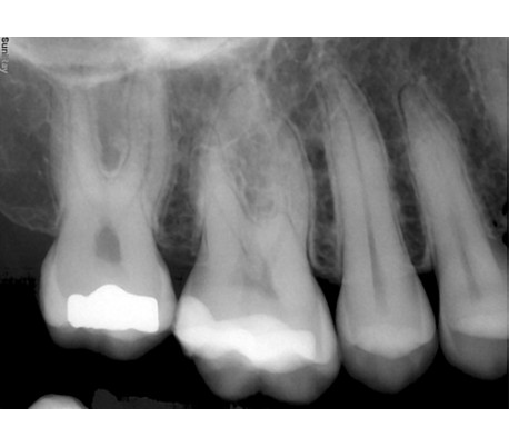 Suni - SuniRay2 Digital X-Ray Sensor