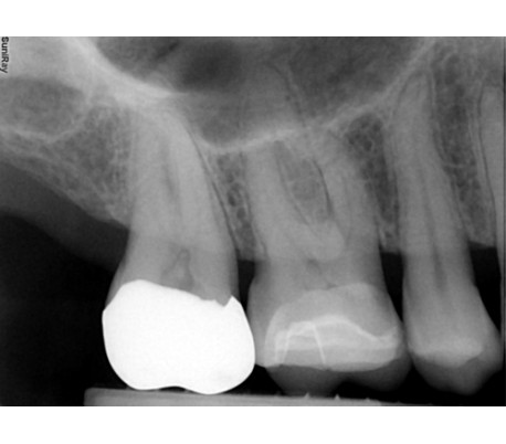 Suni - SuniRay2 Digital X-Ray Sensor